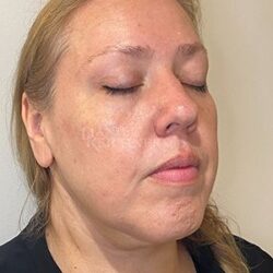 Facelift / Necklift