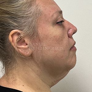 Facelift / Necklift