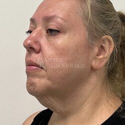 Facelift / Necklift