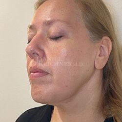 Facelift / Necklift