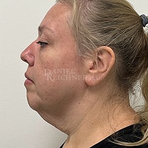 Facelift / Necklift