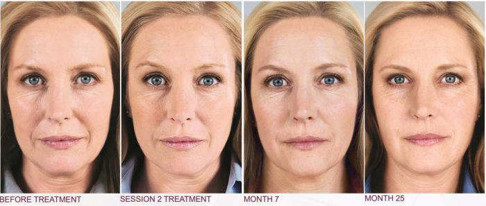 Sculptra Results Over Time