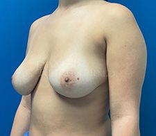 Breast Reduction