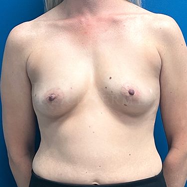 Breast Augmentation