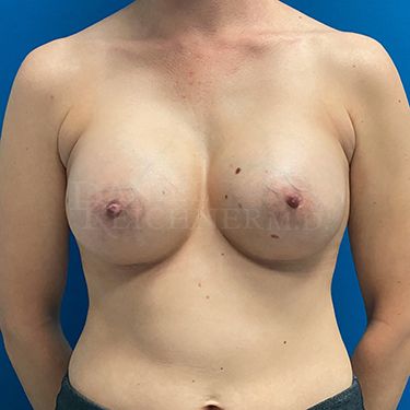 Breast Augmentation