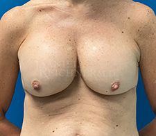 Breast Revision