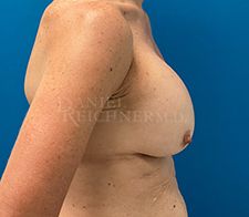 Breast Revision