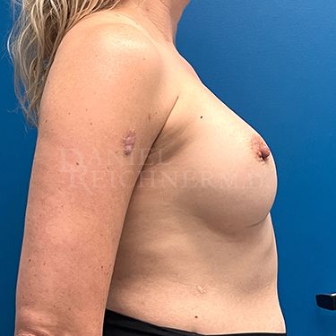 Breast Augmentation