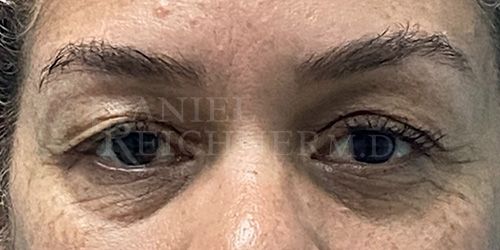 Eyelid Surgery Case 18612 Before Photo Eyelid Surgery