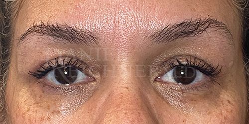 Eyelid Surgery Case 18612 After Photo Eyelid Surgery