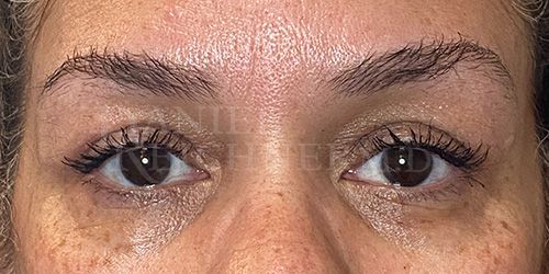 Eyelid Surgery