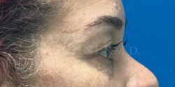 Eyelid Surgery