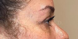 Eyelid Surgery