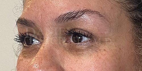 Eyelid Surgery