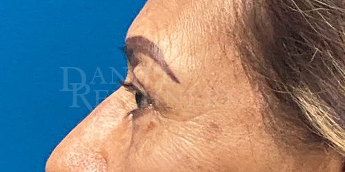 Eyelid Surgery