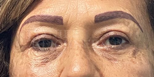 Eyelid Surgery Case 18562 After Photo Eyelid Surgery