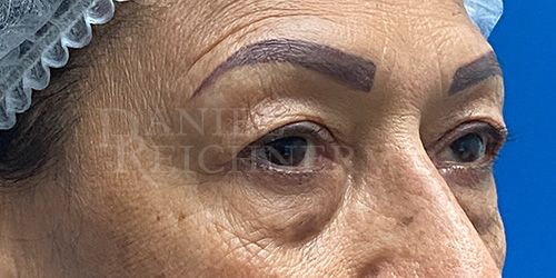 Eyelid Surgery