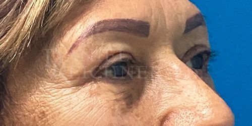 Eyelid Surgery