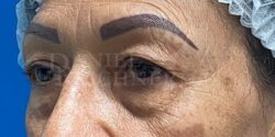 Eyelid Surgery