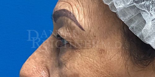 Eyelid Surgery