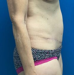 Abdominoplasty (Tummy Tuck)