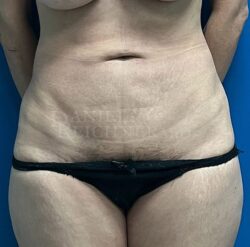 Abdominoplasty (Tummy Tuck)