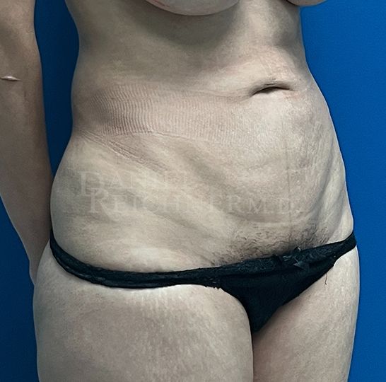 Abdominoplasty (Tummy Tuck)