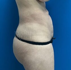 Abdominoplasty (Tummy Tuck)