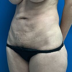 Abdominoplasty (Tummy Tuck)