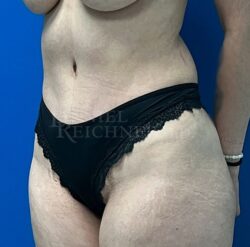 Abdominoplasty (Tummy Tuck)