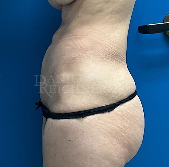 Abdominoplasty (Tummy Tuck)