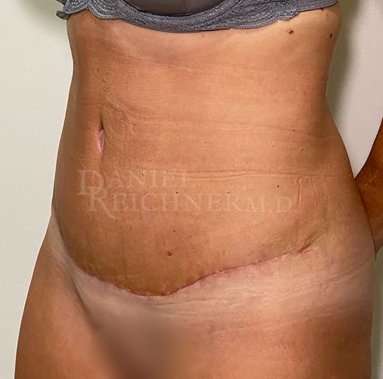 Abdominoplasty (Tummy Tuck)