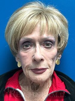 Facial Fat Grafting: Before & After Photos