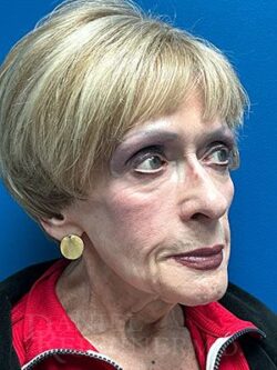 Facial Fat Grafting: Before & After Photos