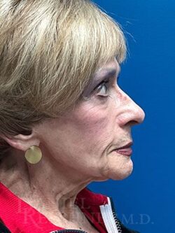 Facial Fat Grafting: Before & After Photos