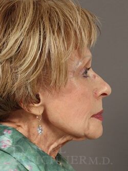 Facial Fat Grafting: Before & After Photos