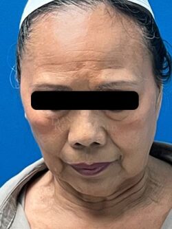 Facial Fat Grafting: Before & After Photos