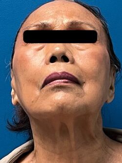 Facial Fat Grafting: Before & After Photos