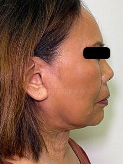 Facial Fat Grafting: Before & After Photos