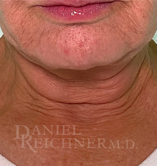 Facelift / Necklift