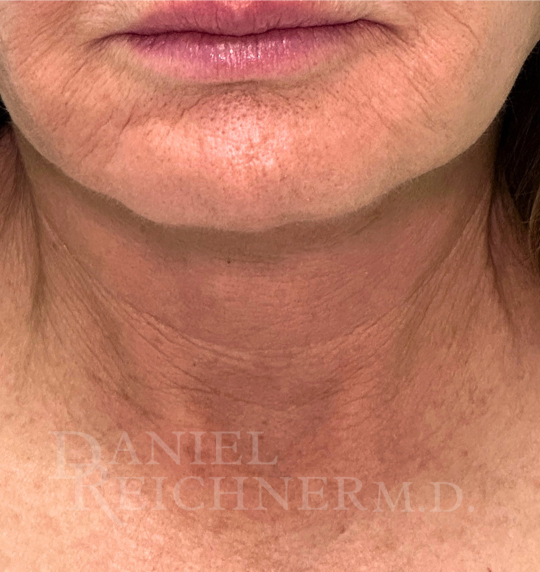 Facelift / Necklift