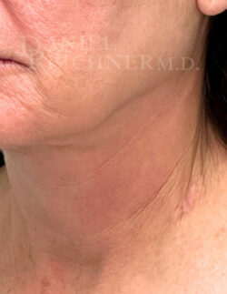 Facelift / Necklift