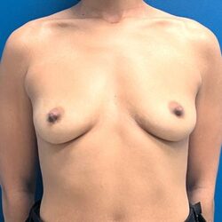 Breast Augmentation