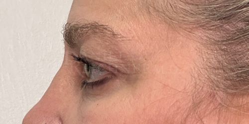 Eyelid Surgery