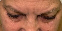 Eyelid Surgery