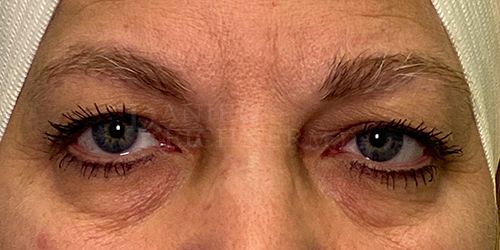 Eyelid Surgery