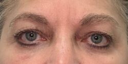 Eyelid Surgery