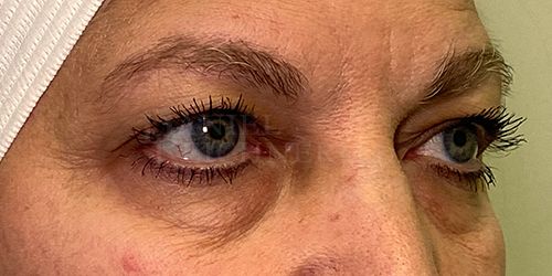 Eyelid Surgery