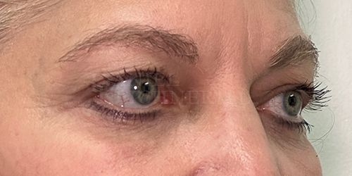 Eyelid Surgery