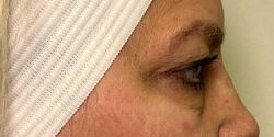 Eyelid Surgery